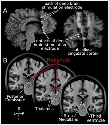 Habenular Involvement in Response to Subcallosal Cingulate Deep Brain Stimulation for Depression